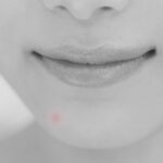 皮膚科のにきび治療